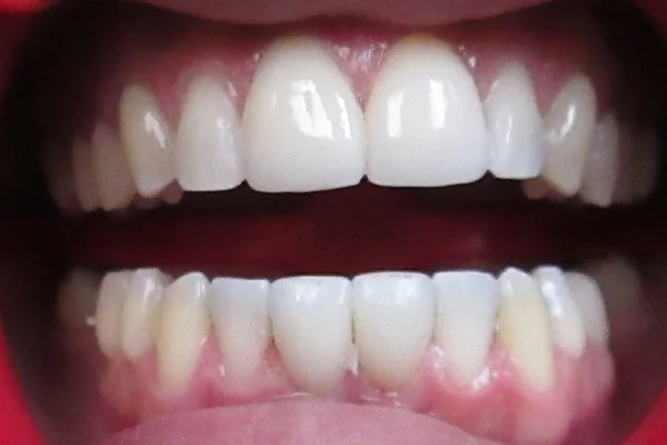 After treatment: even, closed smile