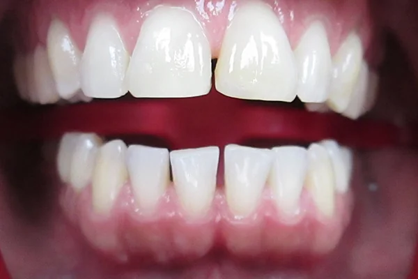 Before treatment: gap between front teeth