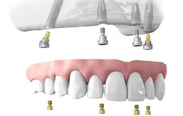 Illustration of a full fixed bridge attached to implants