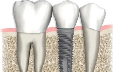 Illustration of a dental implant replacing a single tooth between natural teeth