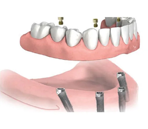 Illustration of a lower denture that snaps onto implants